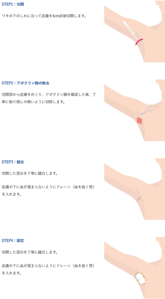 剪除法手術